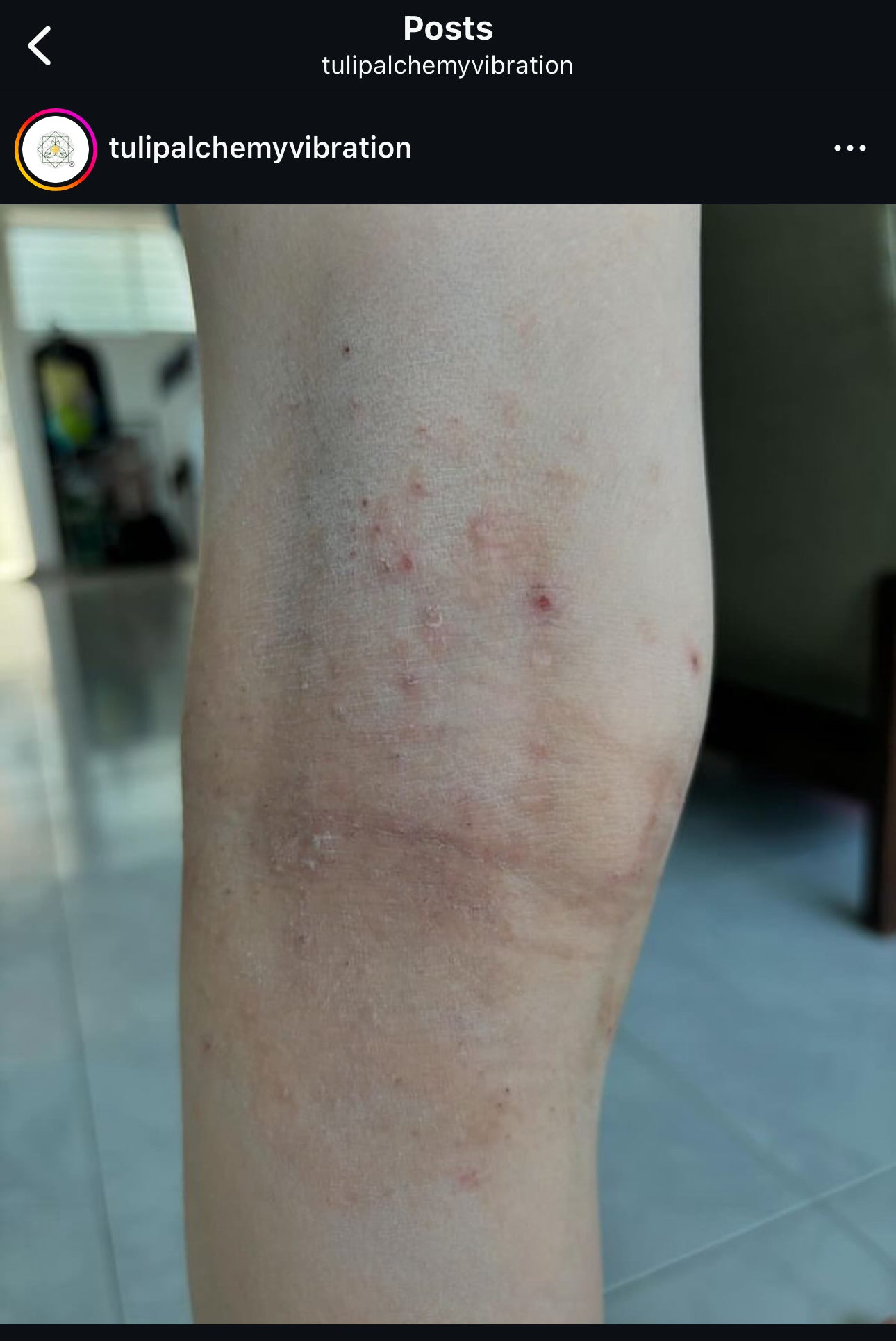 Cellulite Body